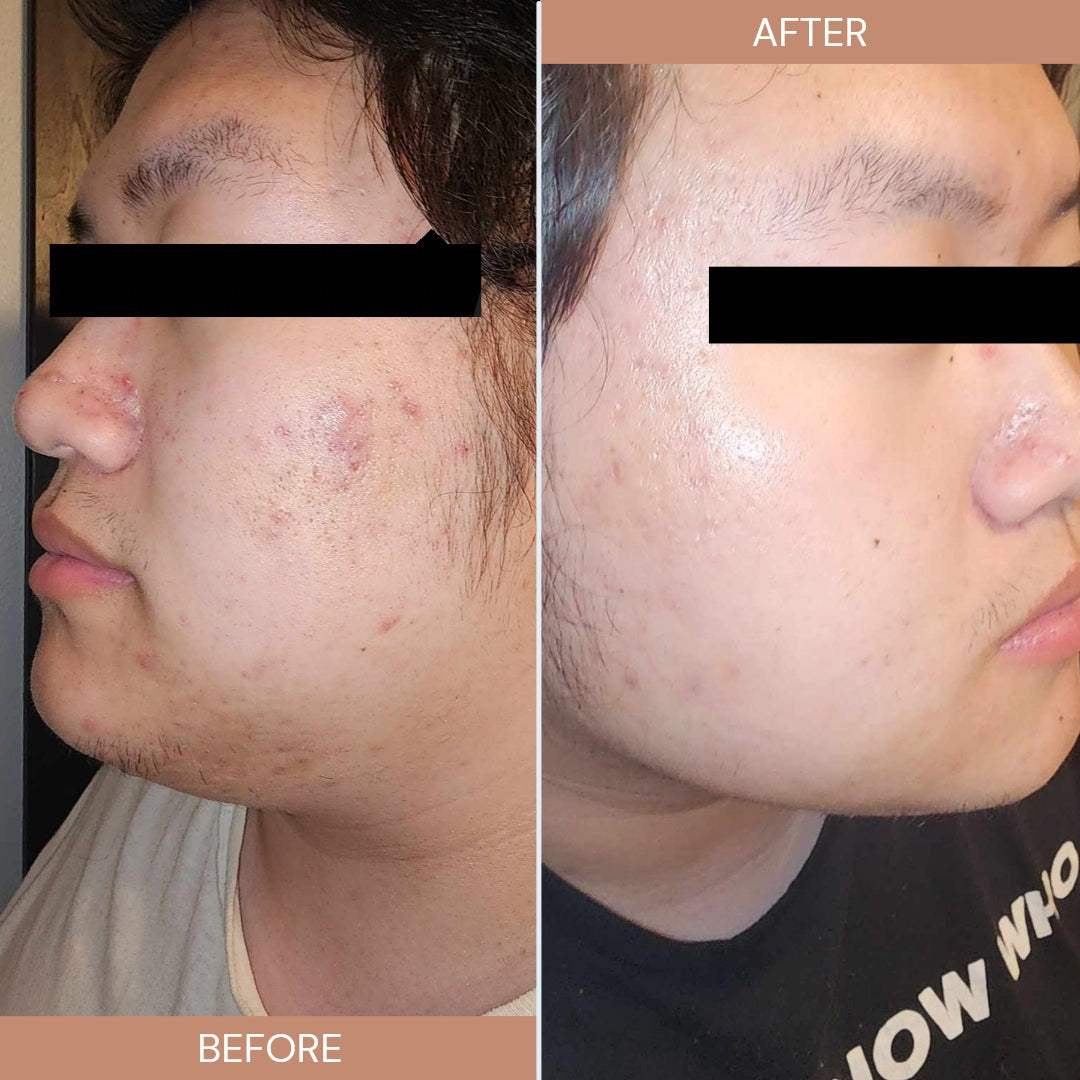 Herbal Tea Tree Acne Cream, 30mL