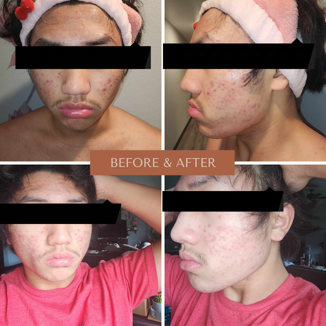 Herbal Tea Tree Acne Cream, 30mL